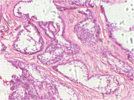 Figure 4: Photomicrograph showing ameloblastomatous islands with peripheral tall columnar cells and central stellate reticulum like cells. (H & E, 20x).